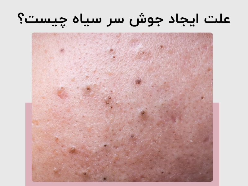 علت ایجاد جوش سر سیاه چیست؟