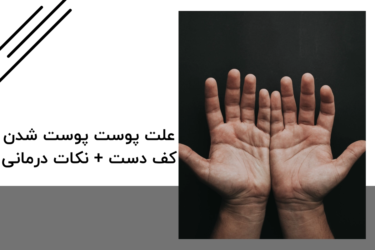 علت پوست پوست شدن کف دست + نکات درمانی