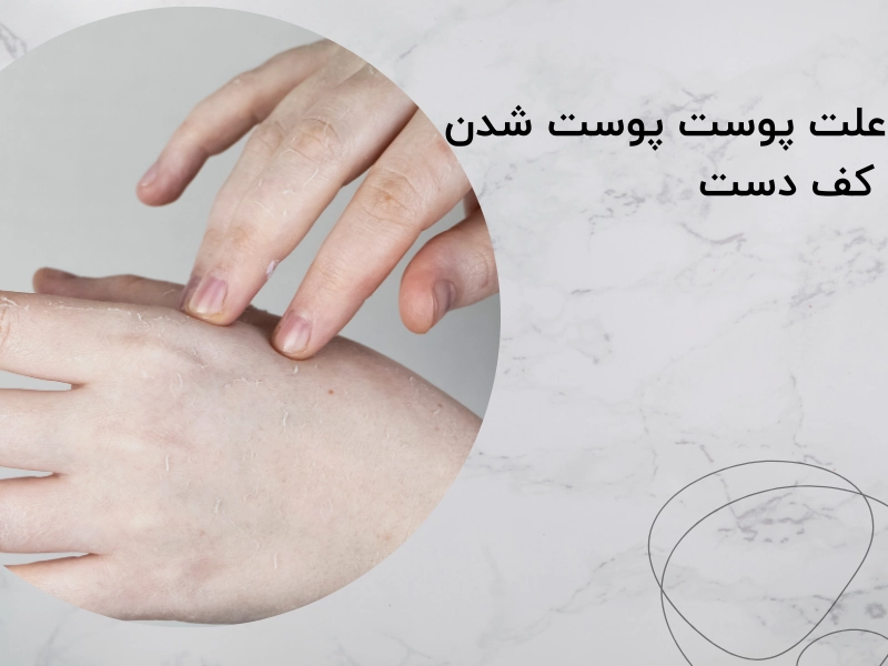 علت پوست پوست شدن کف دست