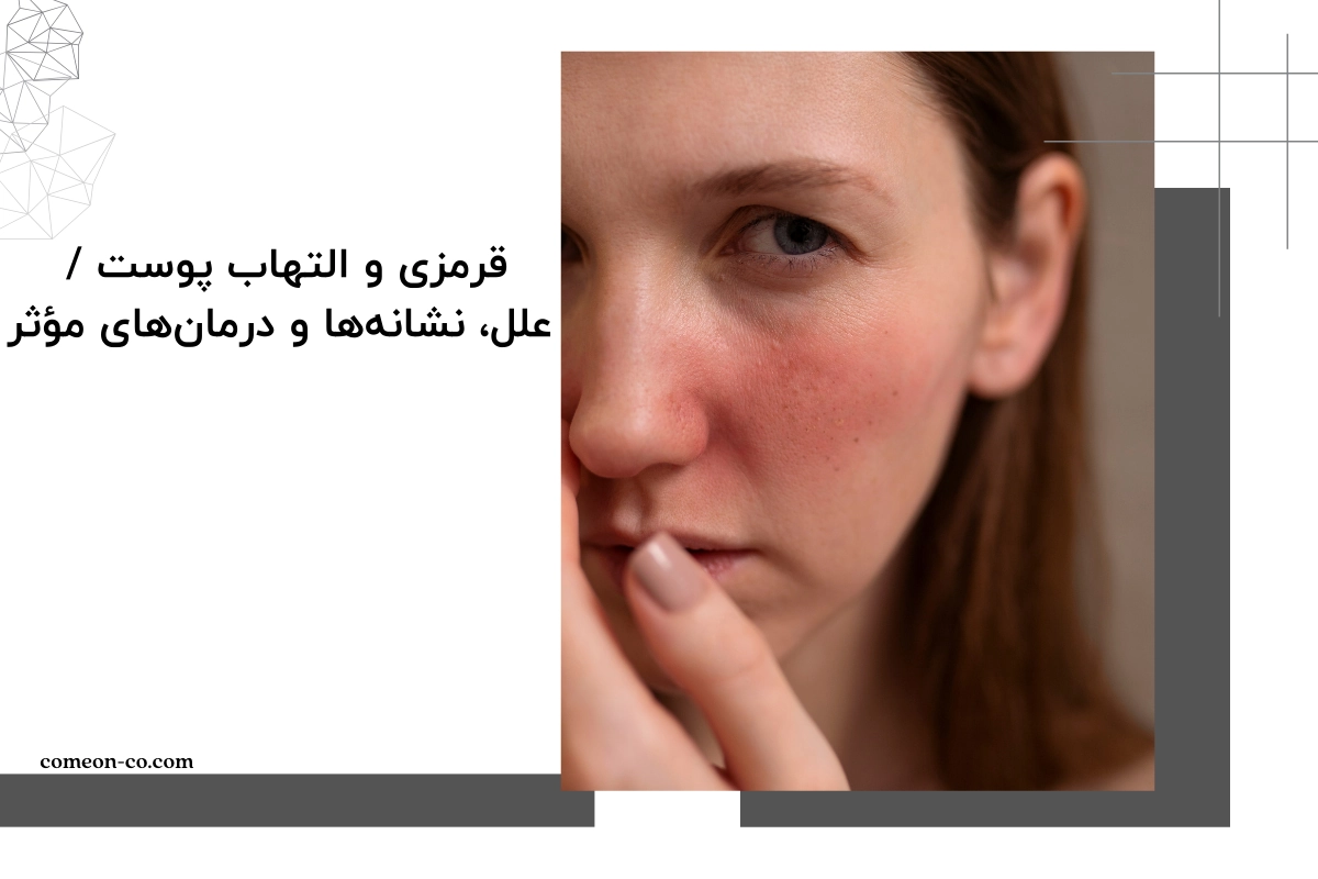 قرمزی و التهاب پوست / علل، نشانهها و درمان های مؤثر