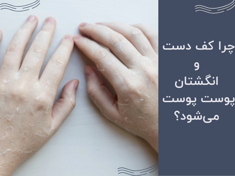 چرا کف دست و انگشتان پوست پوست میشود؟