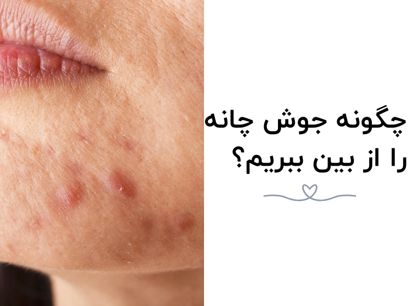 چگونه جوش چانه را از بین ببریم