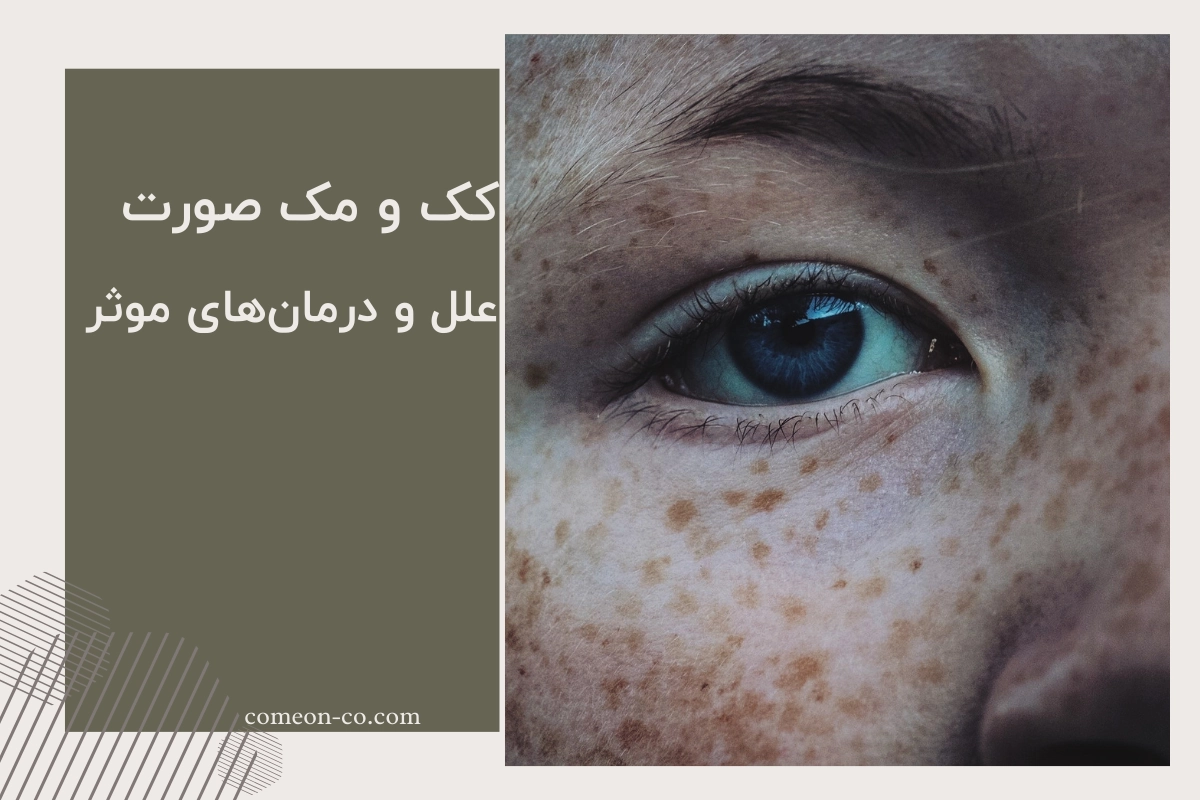 کک و مک صورت / علل و درمانهای موثر