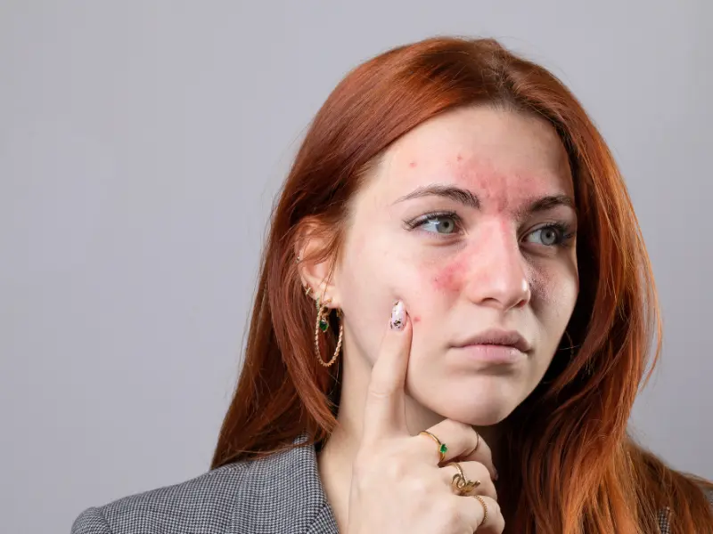 روش‌های پیشگیری از آکنه روزاسه