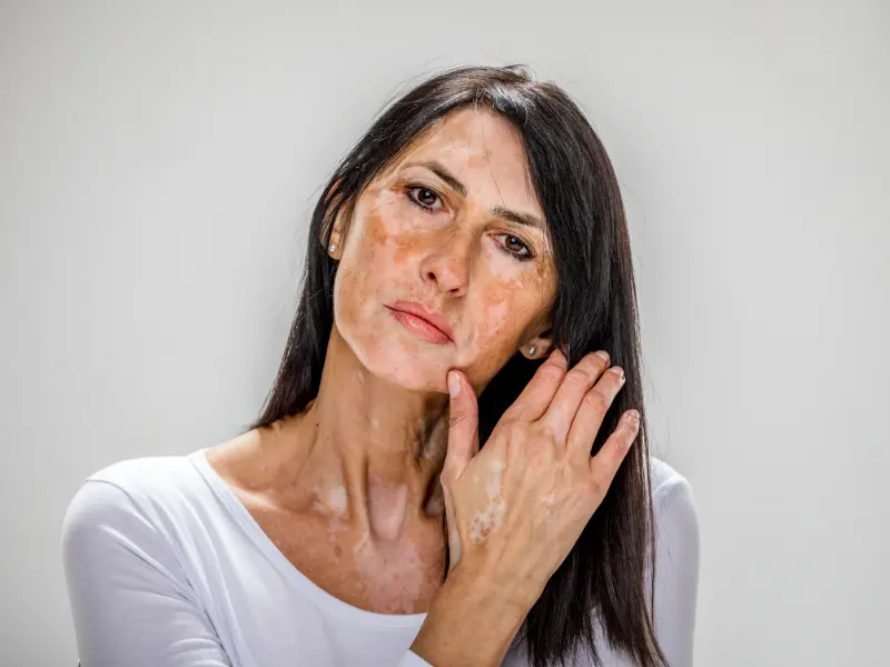 علت آسیب دیدن سد دفاعی پوست