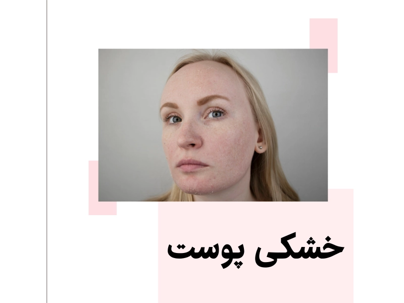خشکی پوست