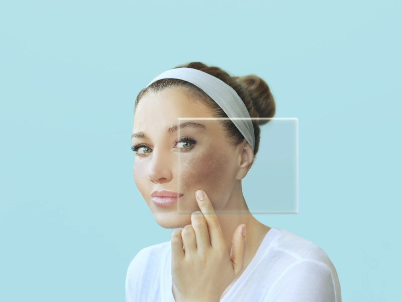 درمان تاثیر تیروئید بر پوست