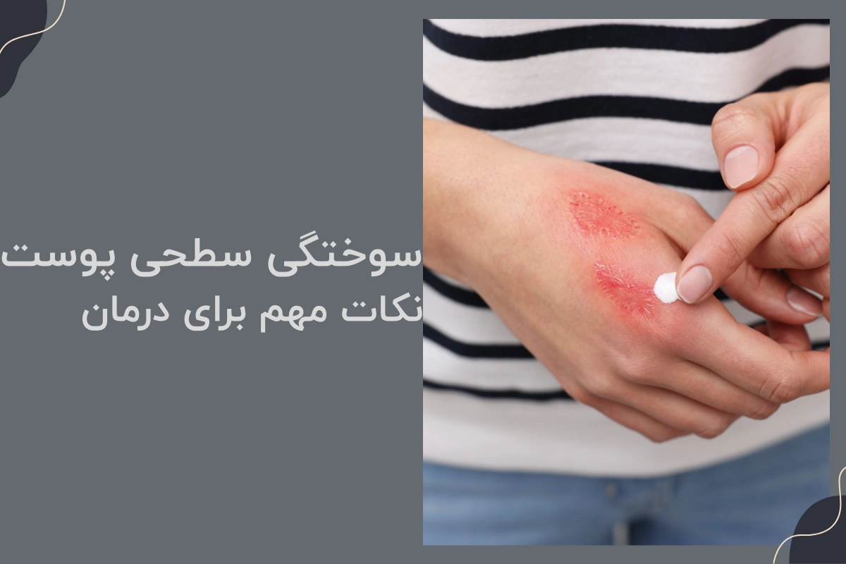 سوختگی سطحی پوست / نکات مهم برای درمان