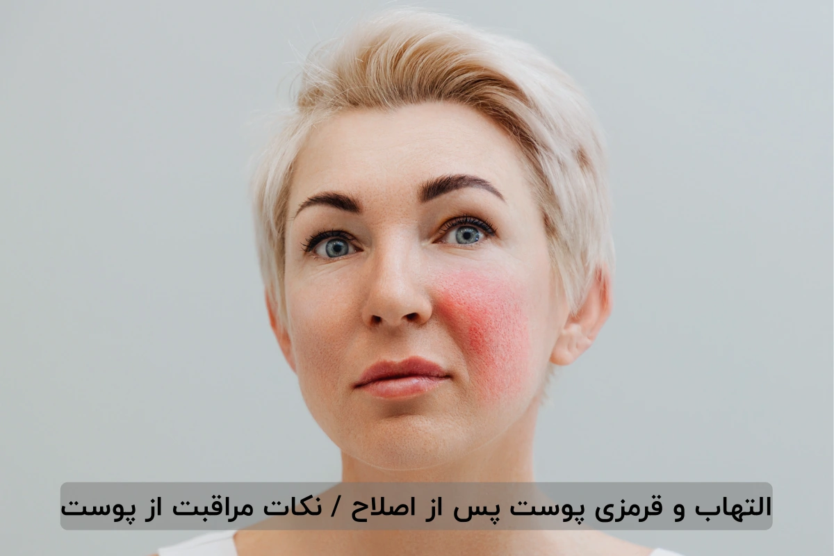 التهاب و قرمزی پوست پس از اصلاح / نکات مراقبت از پوست