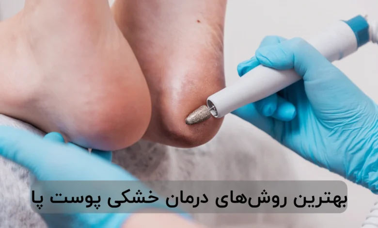 بهترین روشهای درمان خشکی پوست پا