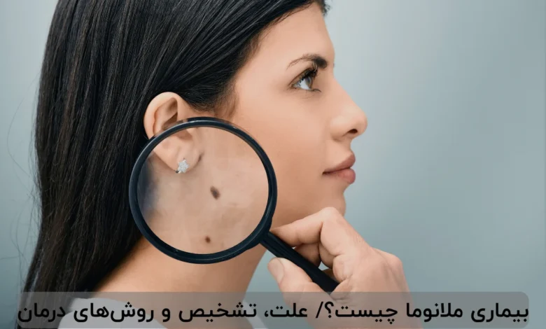 بیماری ملانوما چیست؟/ علت، تشخیص و روش‌های درمان