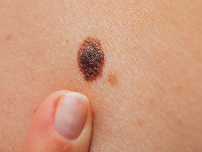 بیماری ملانوما چیست؟