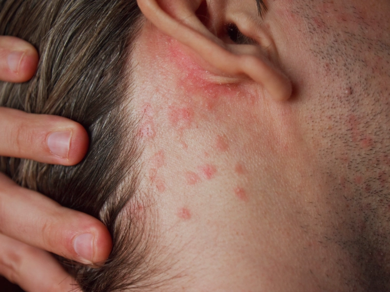 راهکارهای خانگی و مراقبتی برای درمان راش پوستی در بزرگسالان و کودکان