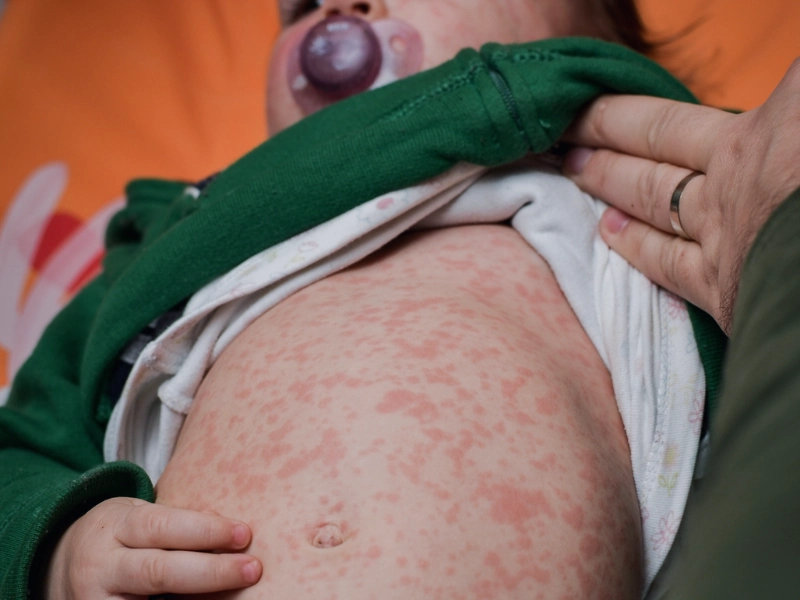 علت بروز ‌‌‌راش پوستی