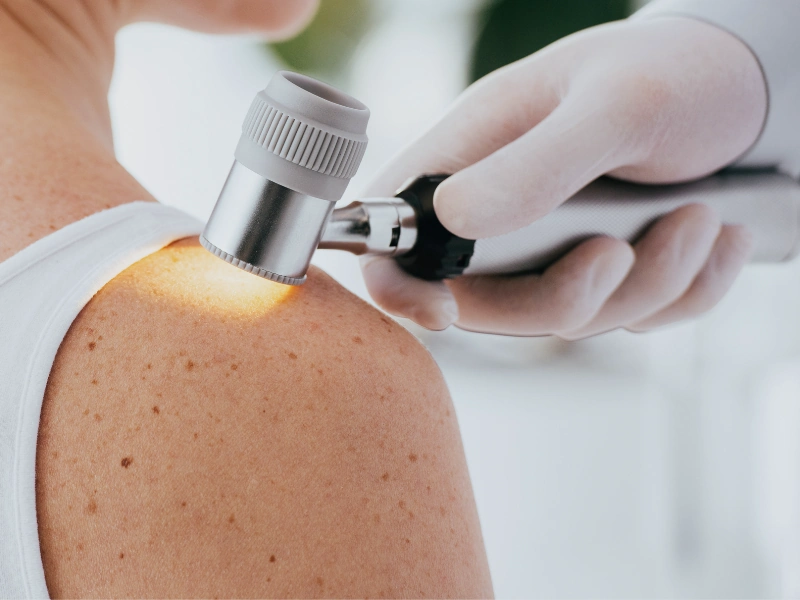 عوامل خطر ابتلا به ملانوما