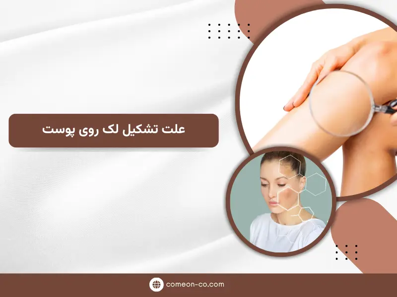 علت تشکیل لک روی پوست